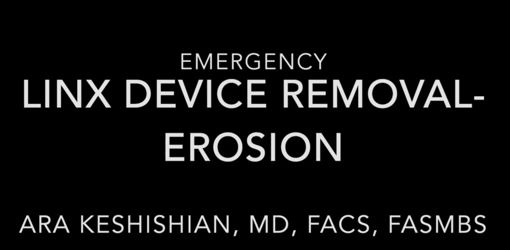 LINX Device Revomal For Erosion